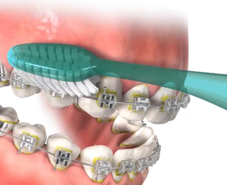 Example of proper brushing technique for braces showing teeth with braces and a toothbrush
