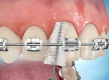 Interproximal brush recommended for patients with braces